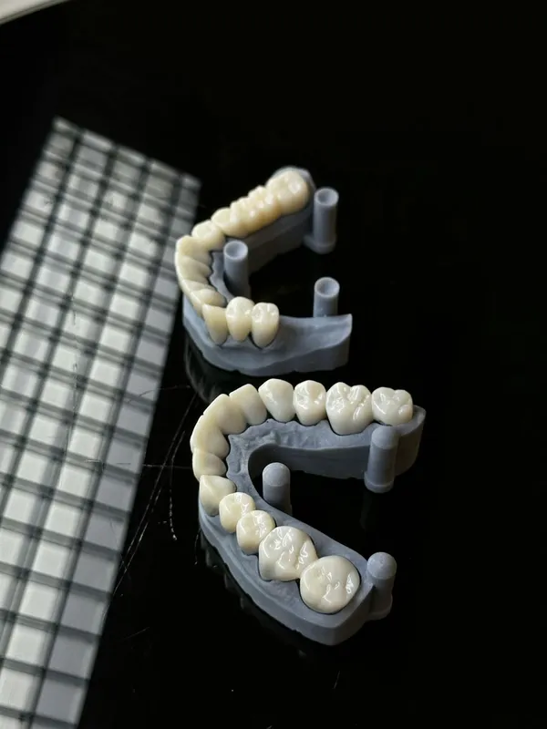 Zirconia dental crown fabrication in a dental laboratory — the premium crown material available at accredited Turkish clinics at 70–75% below UK private costs